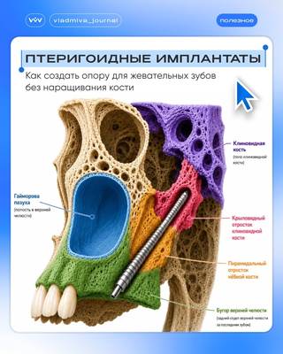 Птеригоидный имплантат: обход атрофии через крыловидный отросток.